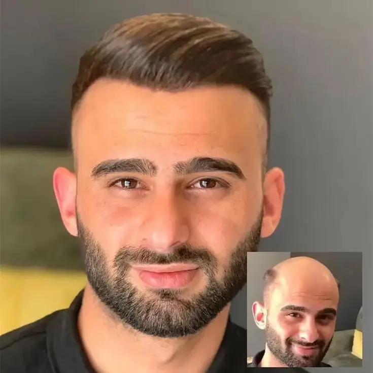 FFP | French Lace with Thin Skin Hairpieces for Thinning Hair - Image 6