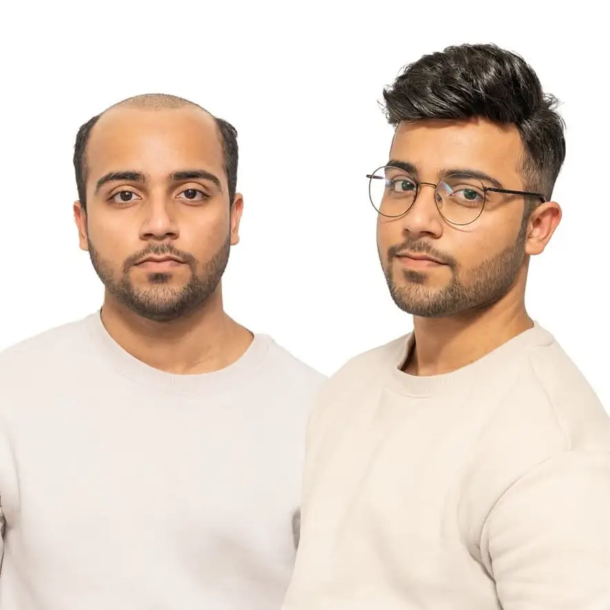 0.03mm Ultra Thin Skin V-looped man with toupee pu0311 - Image 6