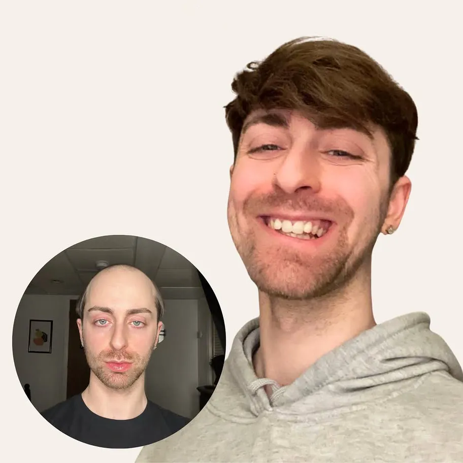 0.03mm Ultra Thin Skin V-looped man with toupee pu0311 - Image 8