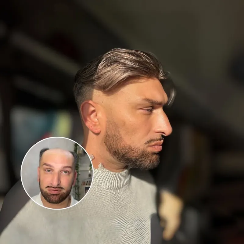 0.06mm Ultra Thin Skin V-looped toupee for men's hair p0677 - Image 6