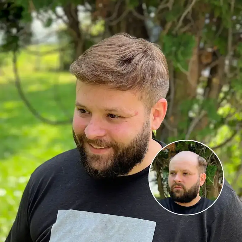 0.06mm Ultra Thin Skin V-looped toupee for men's hair p0677 - Image 4